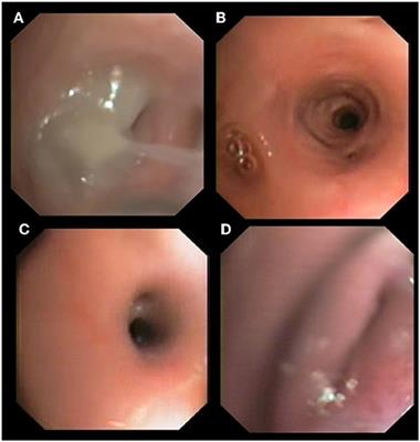 Evaluation of Bronchoscopy and Bronchoalveolar Lavage Findings in Cats With Aelurostrongylus abstrusus in Comparison to Cats With Feline Bronchial Disease